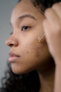 How To Care For Acne-Prone Skin