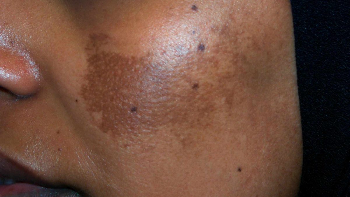 Hyperpigmentation on dark skin. Post-inflammatory hyperpigmentation.