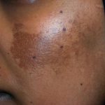 Hyperpigmentation on dark skin. Post-inflammatory hyperpigmentation.