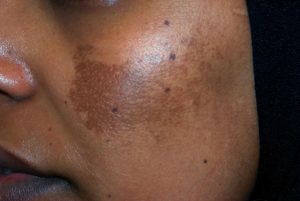 Hyperpigmentation on dark skin