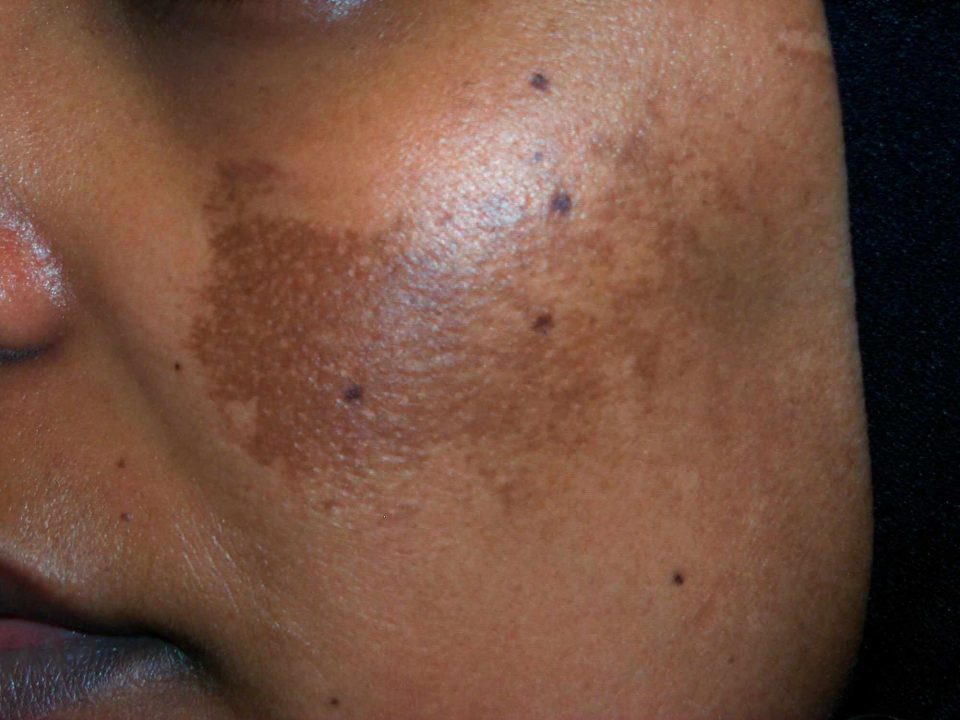 Hyperpigmentation on dark skin. Post-inflammatory hyperpigmentation.