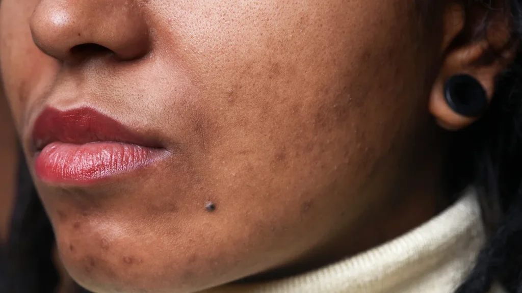 Hyperpigmentation on dark skin. Post-inflammatory hyperpigmentation.