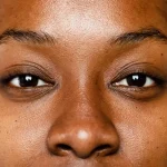 Hyperpigmentation on dark skin