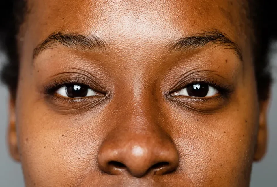 Hyperpigmentation on dark skin