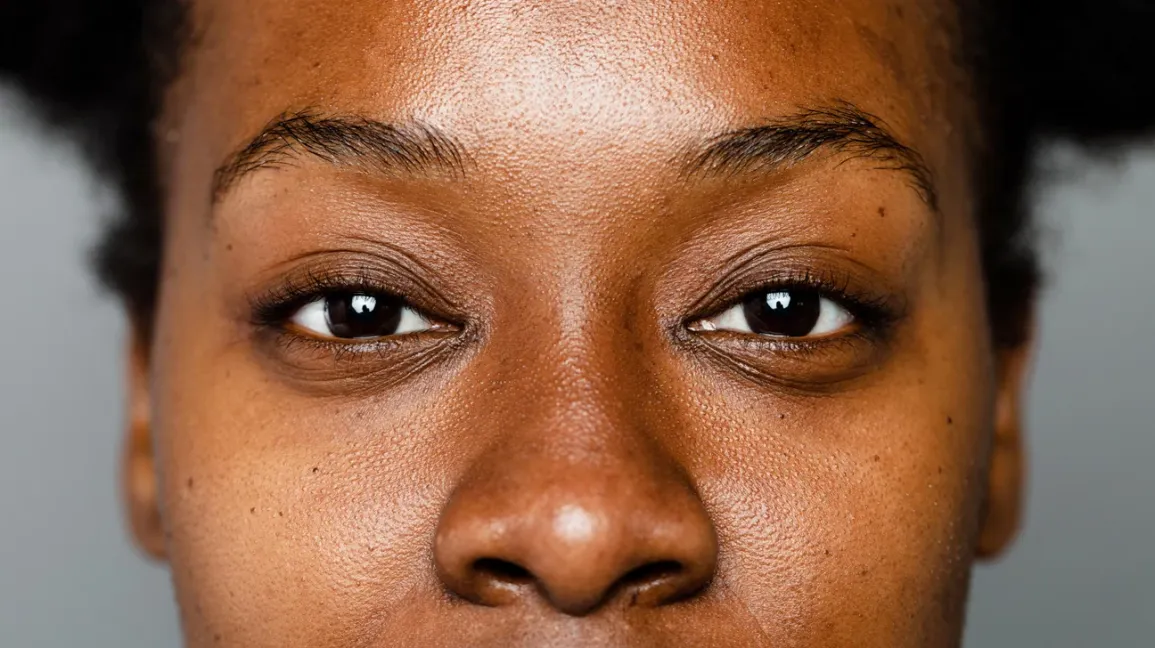 Hyperpigmentation on dark skin