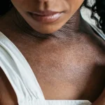 Eczema on dark skin