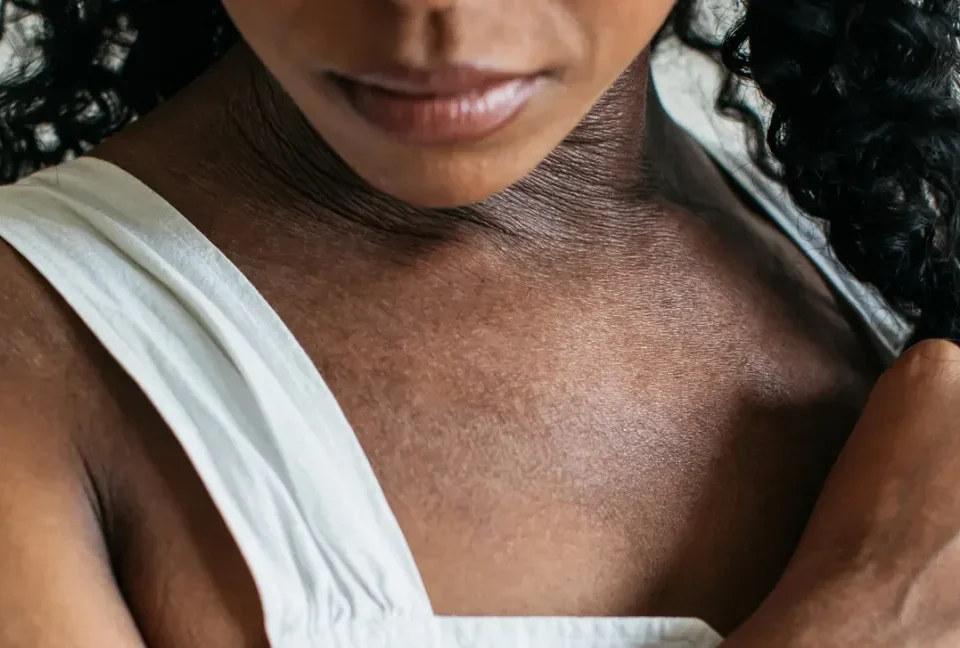 Eczema on dark skin