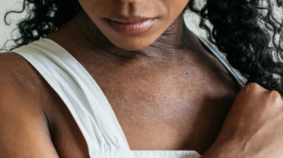 Eczema on dark skin