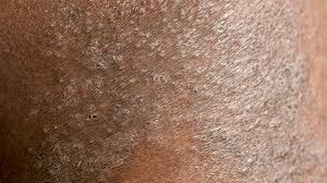 Eczema on dark skin